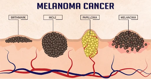 Advanced Treatments for Melanoma and Non-Melanoma Skin Cancers