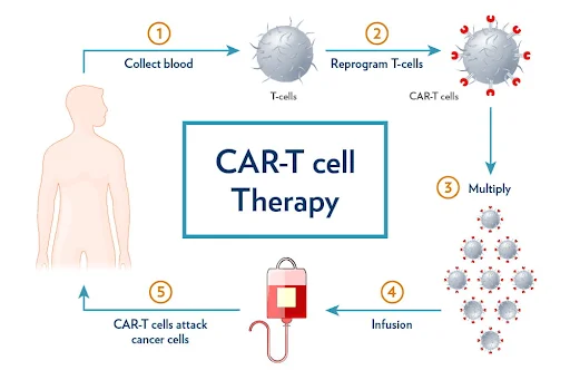 CAR T-Cell Therapy: A New Hope in Cancer Treatment