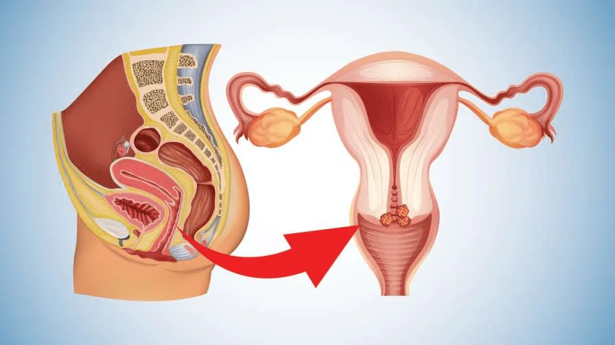 Can Cervical Cancer Be Cured? Understanding Survival Rates and Treatment Success