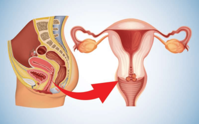 Can Cervical Cancer Be Cured? Understanding Survival Rates and Treatment Success